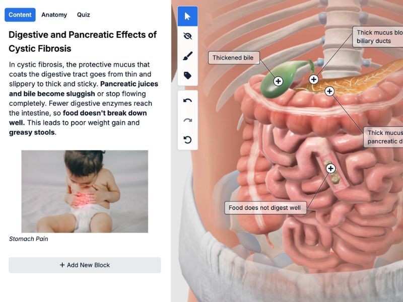 Customizable Cystic Fibrosis Content – Add Images and Visual Annotations