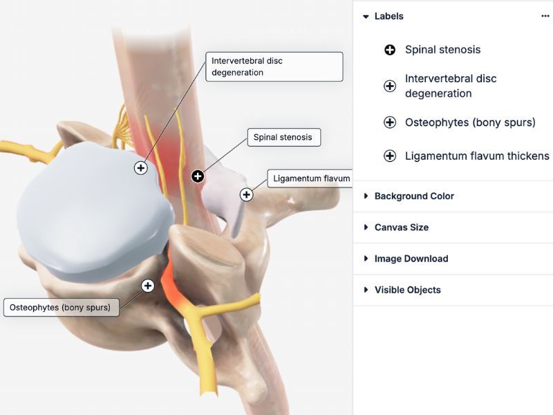 Posterior Cervical Spinal Fusion Labels – BioDigital Studio for Device Sales Training